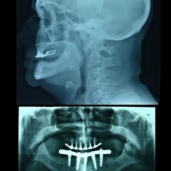 Uni Maxillary edentulous treatment